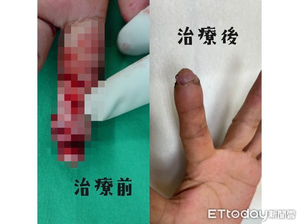 ღ52歲李姓女子在工業區上班，因為操作機具不當，導致右手指被機器捲入。（Picture /麻豆許宥孺翻攝）