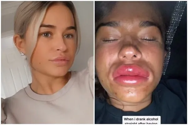▲▼女子打完豐唇玻尿酸就去喝酒，嘴唇腫成香腸。（圖／翻攝TikTokTikTok@mp1997x）