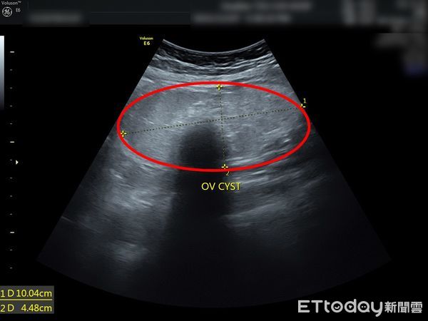 ▲▼婦科超音波顯示陳小姐同時有子宮肌瘤（右圈）及卵巢瘤（左圈）。（圖／慈濟醫學中心提供，下同）