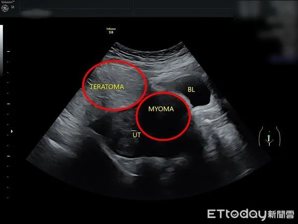 ▲▼婦科超音波顯示陳小姐同時有子宮肌瘤（右圈）及卵巢瘤（左圈）。（圖／慈濟醫學中心提供，下同）