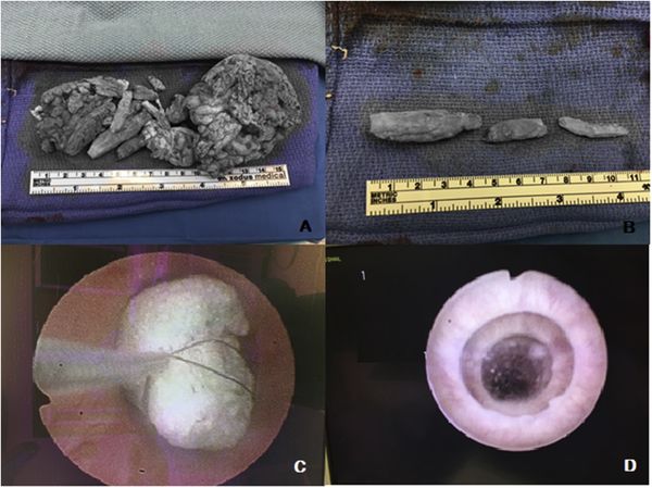 ▲▼醫生採用了「會陰尿道造口術」（Perineal Urethrostomy），在男子的陰囊和肛門處開出一個新口，將硬化的泡沫從尿道內取出。（圖／翻攝自Urology Case Reports）