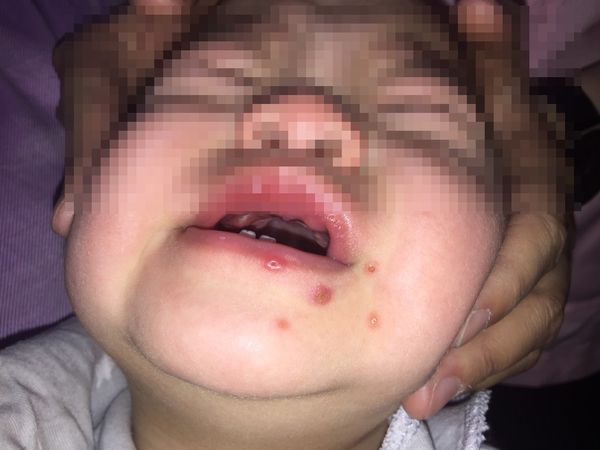 ▲▼1歲多雙胞胎口腔潰爛罹患「泡疹性齒齦舌炎」。（圖／施勝桓診所提供）
