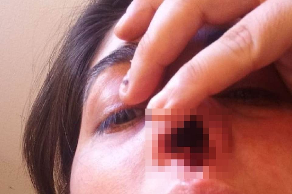 ▲▼ 阿根廷女子做PCR鼻子被戳壞。（圖／翻攝自Facebook）