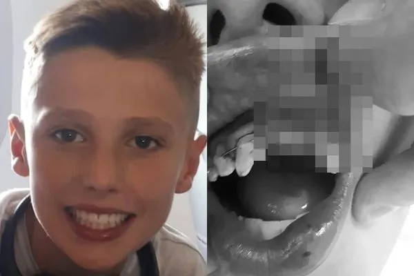 ▲▼男童摔倒「門牙撞進鼻腔」照片曝光。（圖／翻攝自Facebook／Swansea Bay NHS）