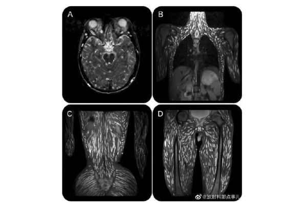 ▲▼核磁共振影像顯示，少年的全身都有絛蟲的蹤跡。（圖／翻攝自放射科那點事兒微博）