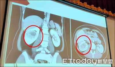 半年腫瘤光速成長5倍宛如棒球大　女台幹返台右腎全切保命