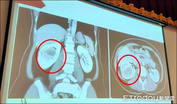 ▲半年腫瘤光速成長5倍大，女台幹返台右腎全切保命。（圖／記者游瓊華攝）