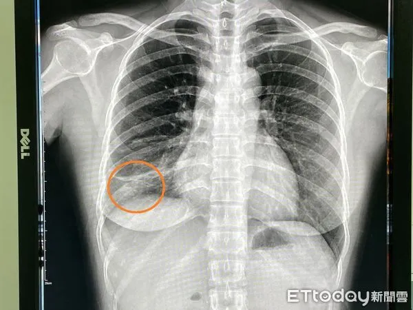 ▲傳播力不輸Omicron！女作業員肺結核連咳2個月　醫驚「下肺葉塌陷了」。（圖／院方提供）