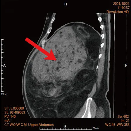 ▲▼病人腹部電腦斷層影像發現巨大腫瘤連脊椎都受到壓迫。（圖／馬偕醫院提供）