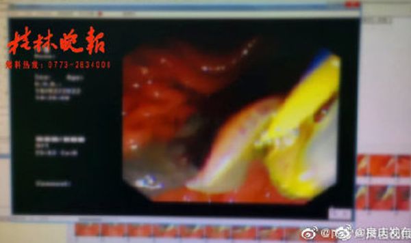 腹痛女「肝臟三分之一被吃掉」　醫取出3.5cm「魚形寄生蟲」驚嚇。（圖／翻攝自微博）