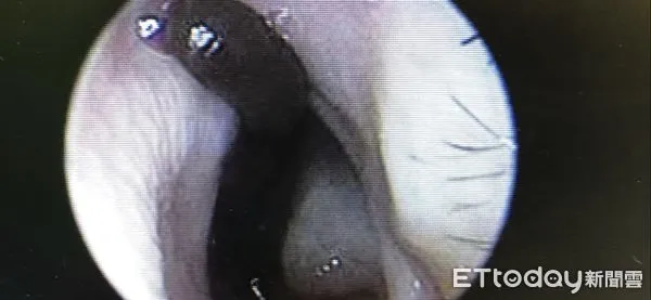 ▲2歲女童送醫後，由內視鏡看到的鼻蛭影像。（圖／慈濟醫學中心提供，下同）