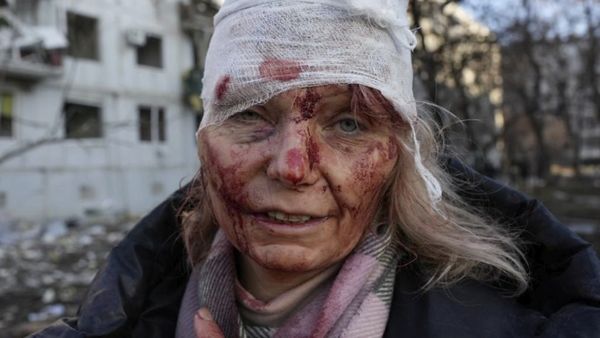 ▲▼烏克蘭第二大城哈爾科夫（Kharkiv）一位婦女受傷頭包紗布。（圖／路透社）