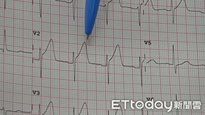 心電圖有異！台東翁心肌梗塞「正在發生」 　1小時植2支架救一命