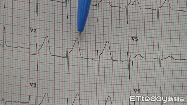 ▲超急性T波在心肌梗塞的初期就發生，臨床上的確少見。（圖／台東醫院提供，下同）