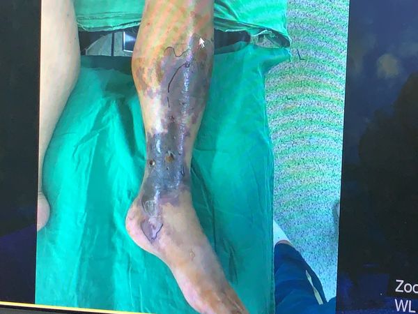 ▲▼他爬大坑步道被眼鏡蛇咬險截肢，14次手術「挖肉補皮」保住左腿。（圖／記者游瓊華翻攝）