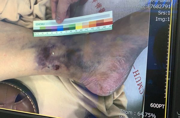 ▲▼他爬大坑步道被眼鏡蛇咬險截肢，14次手術「挖肉補皮」保住左腿。（圖／記者游瓊華翻攝）