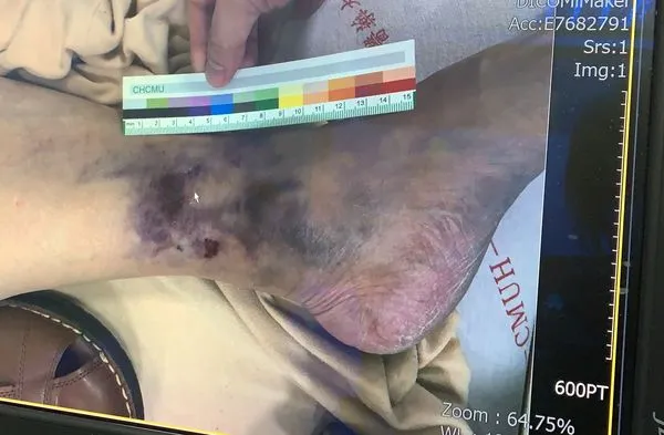 ▲▼他爬大坑步道被眼鏡蛇咬險截肢，14次手術「挖肉補皮」保住左腿。（圖／記者游瓊華翻攝）