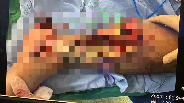 ▲▼他爬大坑步道被眼鏡蛇咬險截肢，14次手術「挖肉補皮」保住左腿。（圖／記者游瓊華翻攝）