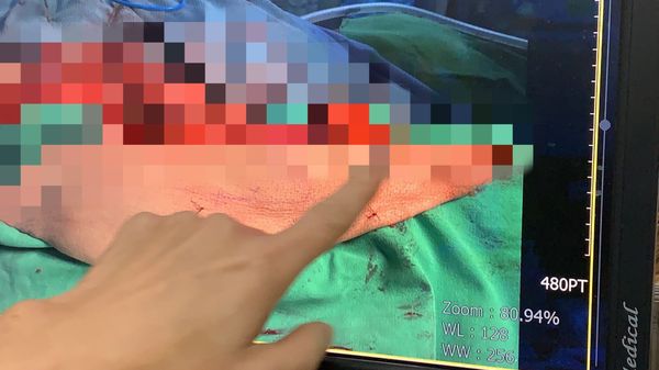 ▲▼他爬大坑步道被眼鏡蛇咬險截肢，14次手術「挖肉補皮」保住左腿。（圖／記者游瓊華翻攝）