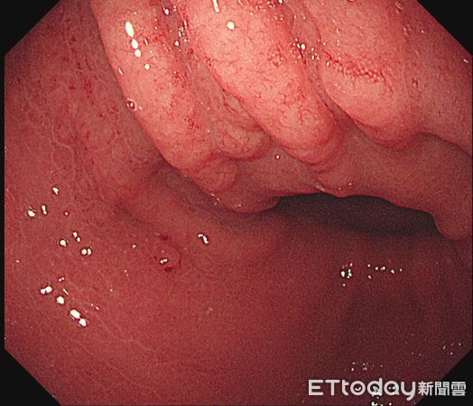 30歲女罹癌「胃壁像苦瓜」！醫驚：什麼症狀都沒有。（圖／林相宏醫師授權提供）