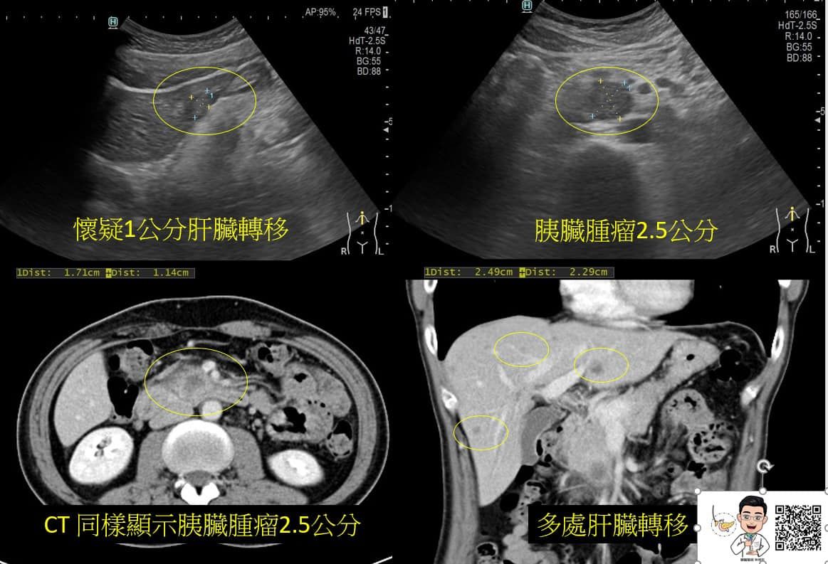 2男罹癌王！醫驚見「5大共通點」：下巴快掉下來　有1症狀已晚期。（圖／林相宏醫師授權提供）