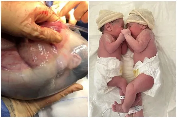 ▲▼西班牙一對女雙胞胎全羊膜生產。（圖／翻攝推特@AnaTeijelo）