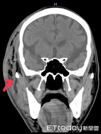 ▲▼男子右側臉部發腫，手術清除膿瘍。（圖／黃書鴻醫師提供）