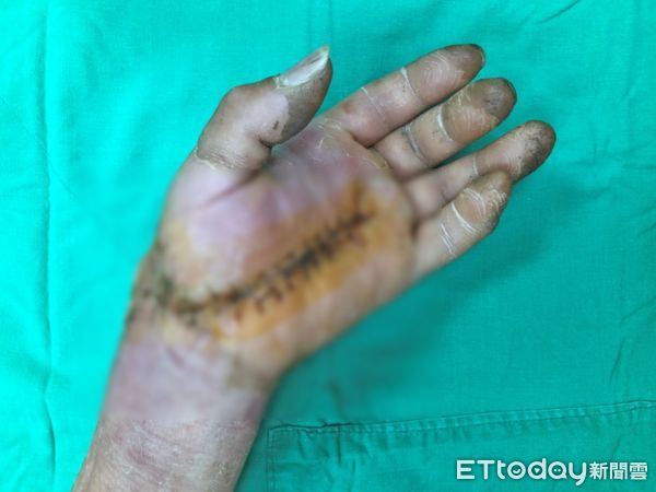 ▲雲林張先生右手掌遭甘蔗機捲入重傷，今日現身記者會，感謝蘇鉉尊醫師與醫療團隊，救回手部功能。（圖／記者蔡佩旻攝）