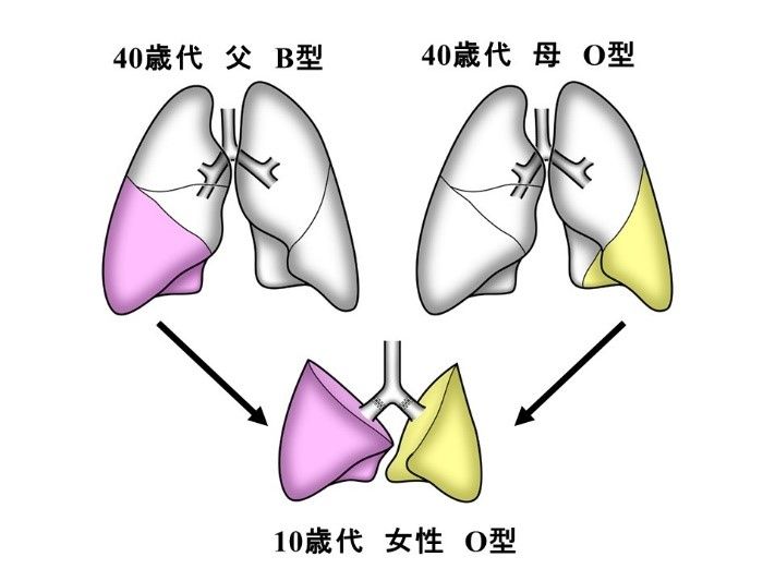 ▲▼全球首例「不同血型」肺部移植成功。（圖／取自京都大學官網）