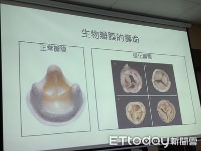 人工瓣膜放10年「退化」致心衰竭　北榮讓高齡患「免開心」續命