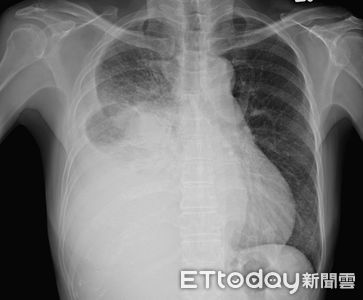 胸腔醫PO「X光整片白照」嘆：已經末期　見她這1習慣搖頭了