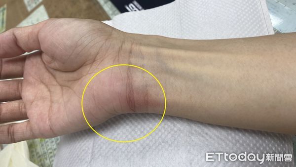 ▲民眾周末防疫在家料理手工丸，卻引發肌腱炎，黃圈處為手腕紅腫熱痛情形。（圖／衛福部南投醫院提供）