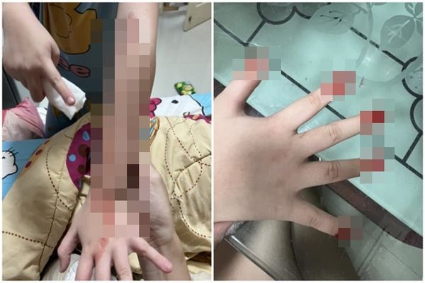 ▲▼泰國7歲女童罹患怪病，包含眼睛、手指在內等身體部位莫名流血。（圖／翻攝Time.news）