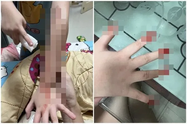 ▲▼泰國7歲女童罹患怪病，包含眼睛、手指在內等身體部位莫名流血。（圖／翻攝Time.news）
