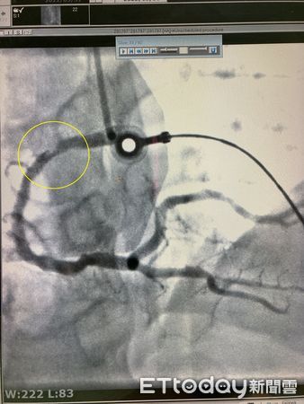 ▲黃圈處為血管栓塞處。（圖／衛福部南投醫院提供）