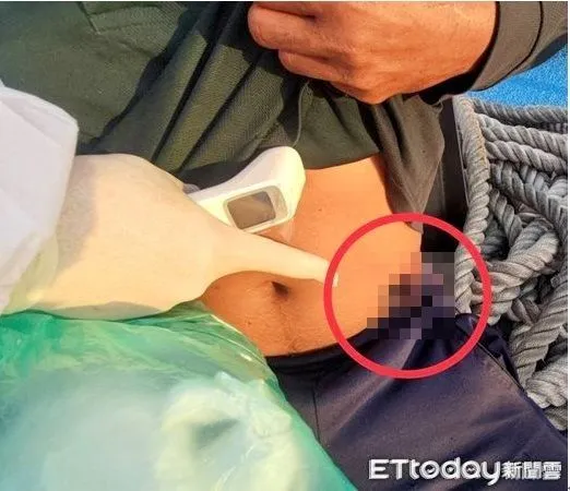 ▲印尼籍漁工被釣鮪魚之大型魚鈎勾入腹部，血流如注痛苦難當。（圖／第六海巡隊提供，下同）