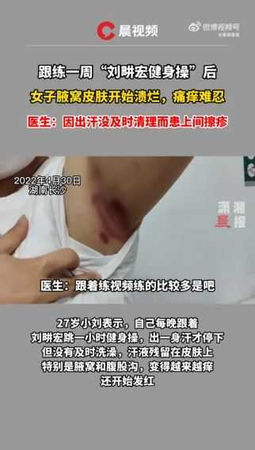 27歲女跳劉畊宏的健身操後未即時盥洗，罹患間擦疹。（圖／翻攝自微博）