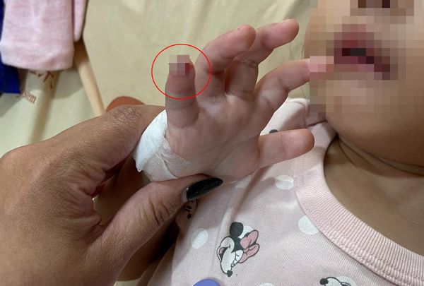 ▲1歲女童拆軟針固定　護理師一剪刀下去…小拇指直接爆血。（圖／翻攝臉書社團《爆料公社》）