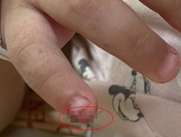 ▲1歲女童拆軟針固定　護理師一剪刀下去…小拇指直接爆血。（圖／翻攝臉書社團《爆料公社》）