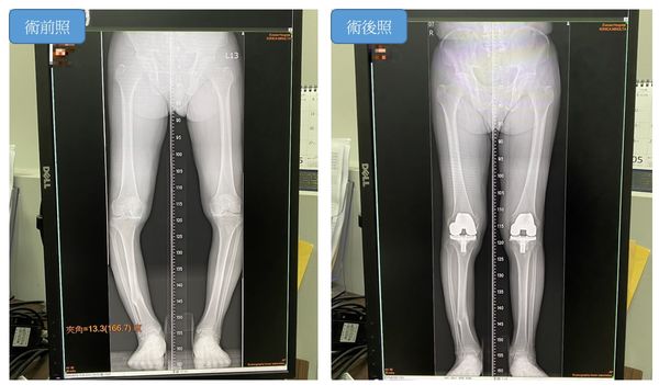▲▼長安醫院醫師楊志鴻透過膝關節微創手術，讓O型腿變成筆直腿。（圖／長安醫院提供）
