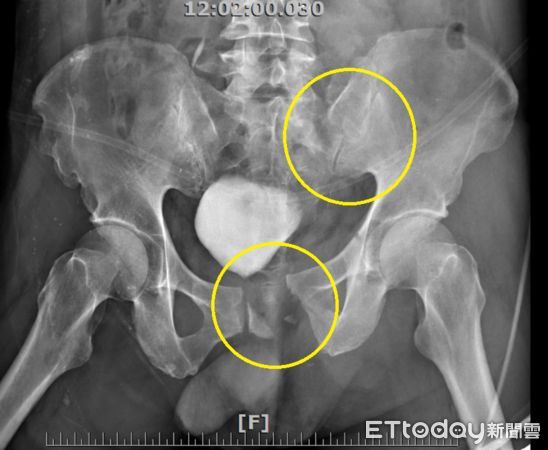 ▲▼患者術前、術後X光影像，黃圈為骨盆骨折處。（圖／衛福部南投醫院提供）