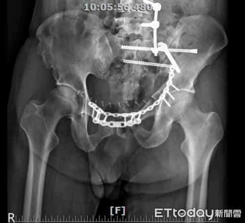 ▲男子從高處墜落致骨盆骨折，南投醫院運用3D列印技術復位治療。（圖／衛福部南投醫院提供）