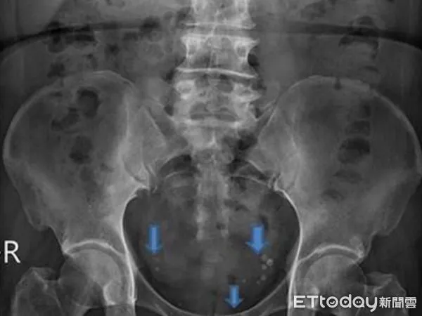 ▲臨床上有些病人可以從腹部X光發現可見鈣化點（藍箭頭白點），這是慢性發炎的證據。(圖／慈濟醫學中心提供，下同）