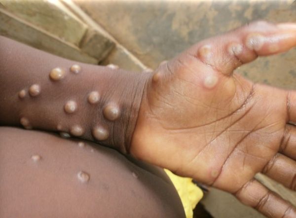 ▲▼猴痘。（圖／翻攝自WHO／Nigeria Centre for Disease Control）