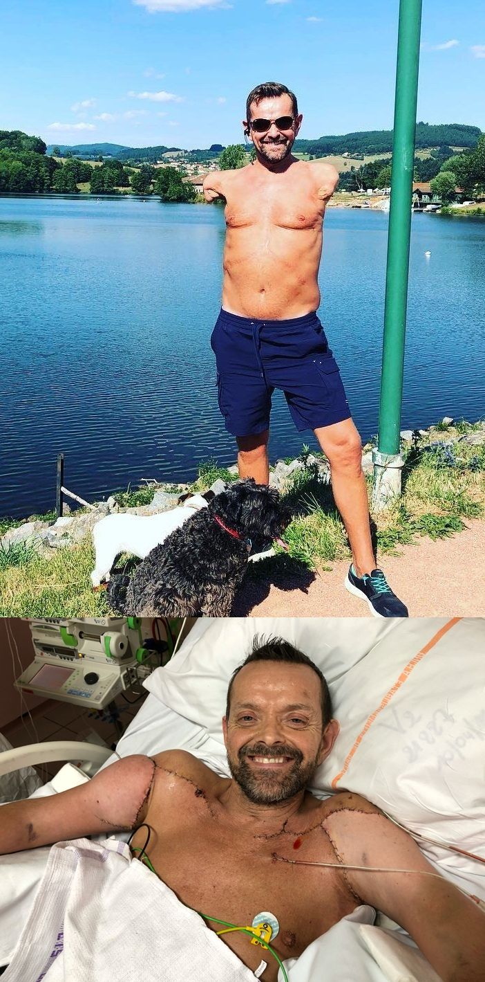 ▲格瑞塔爾森是全球首例成功接受雙臂移植的人。（圖／翻攝推特「@almagoch」）
