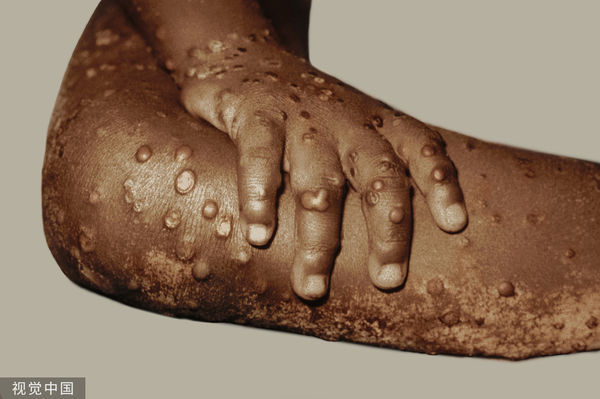 ▲猴痘最明顯症狀就是手腳長出類似水泡的皮疹。（圖／CFP）