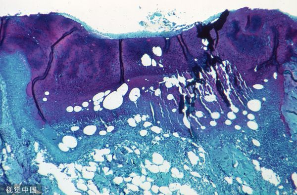 ▲▼一張攝於1968年感染猴痘病毒的猴子皮膚組織切片，在50倍顯微鏡下的影像。（圖／CFP）