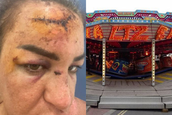 ▲▼梅莉莎（Melissa Hunter）到土耳其玩時遭遊樂設施甩出，鼻子骨折、額頭縫了數十針。（圖／翻攝自推特）