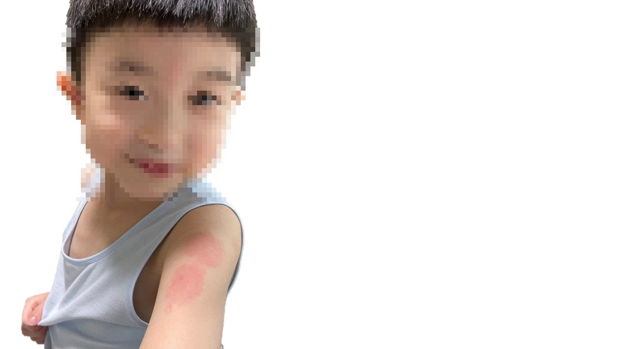 ▲▼兒童打莫德納疫苗後出現新冠手臂。（圖／周宛儀醫師提供）
