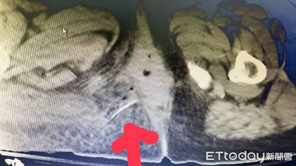 ▲江姓女子吞下了4公分魚刺就卡在靠近肛門的地方             。（圖／記者吳奕靖翻攝）